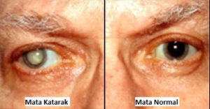 Mata Normal vs Mata Katarak: Obat Herbal Katarak.