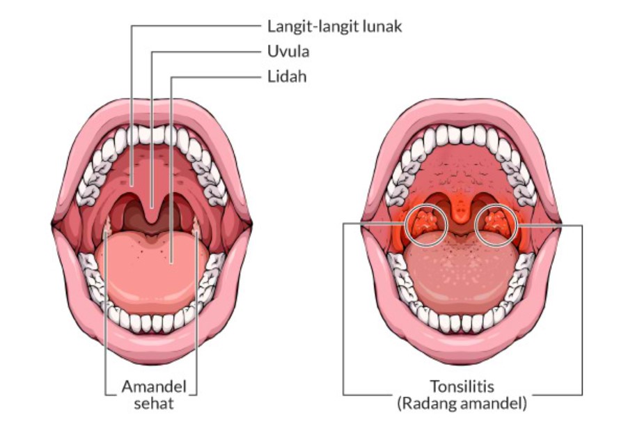 Gejala Amandel: Obat Herbal Amandel.